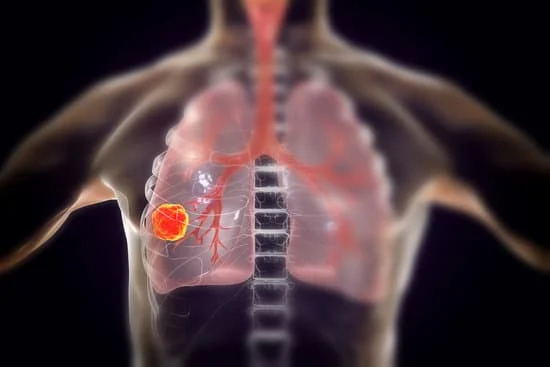 Les symptômes du cancer du poumon de stade 4