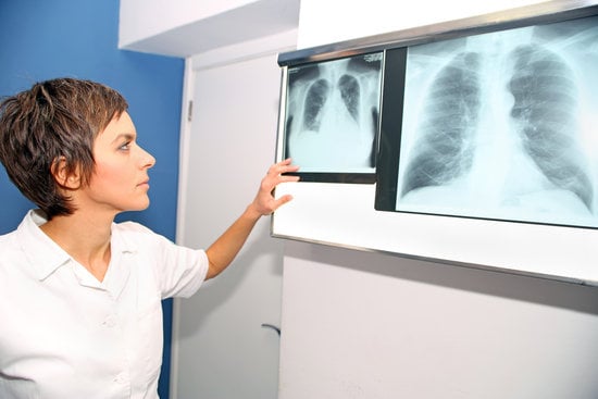 Néoplasie pulmonaire ce qu'il faut savoir