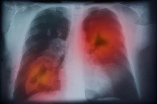 Complications du cancer du poumon avancé